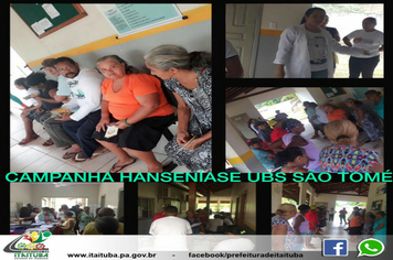 Foto - SAÚDE HANSENÍASE